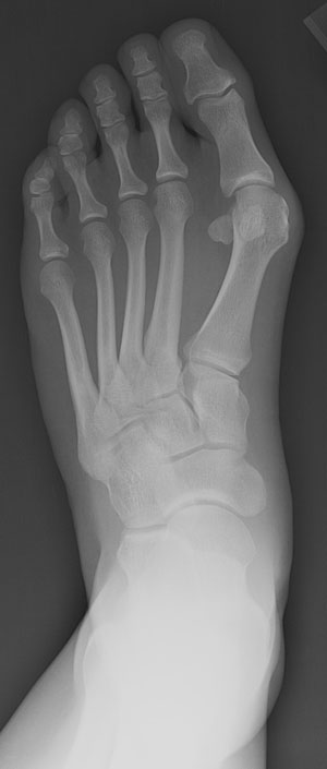 Figure 1 - X-ray view of foot with bunion (hallux valgus)