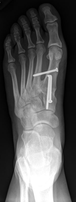 Figure 2 - X-ray view of foot after surgery for bunion (hallux valgus)