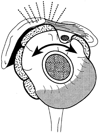 Figure 3 - Positive abrasion sign