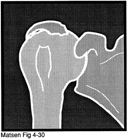 Figure 5 - Cuff tear arthropathy