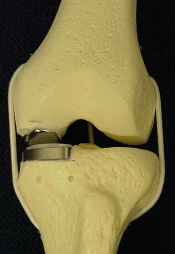 Figure 1 - Model of a partial knee replacement.