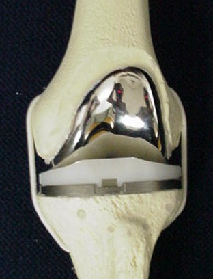 Figure 2 - Model of a traditional total knee replacement. The patella (knee cap) is not shown in this model.