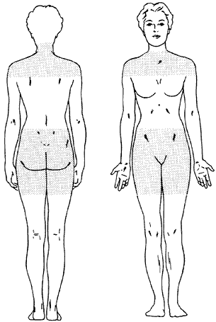 Figure 1 - Areas usually affected by PMR