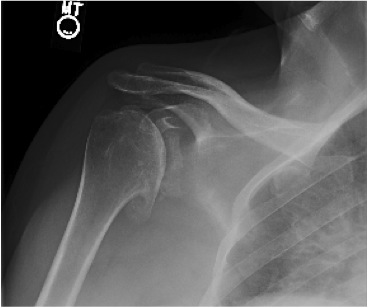 FIGURES 3: X-rays of a 58 year-old woman with severe osteoarthritis of the shoulder. Note the large bone spurs and absence of joint space.