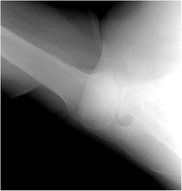 FIGURES4: X-rays of a 58 year-old woman with severe osteoarthritis of the shoulder. Note the large bone spurs and absence of joint space.