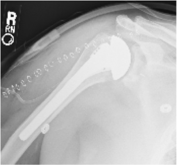 FIGURES 5: X-rays of the same woman in Figures 3 & 4 after Total Shoulder Arthroplasty. Note that the bone spurs have been removed and that the humeral component has been placed inside of the arm bone. The plastic glenoid component is not visible on x-ray.