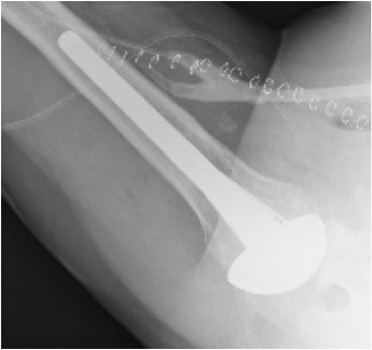 FIGURES 6: X-rays of the same woman in Figures 3 & 4 after Total Shoulder Arthroplasty. Note that the bone spurs have been removed and that the humeral component has been placed inside of the arm bone. The plastic glenoid component is not visible on x-ray.