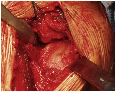 GURE 7: The socket (glenoid) before it has been ground down. Note that nearly all of the normal cartilage has been worn away by the disease process.