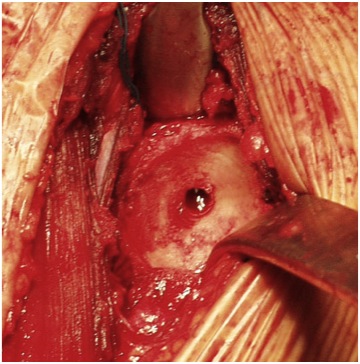FIGURE 8: The socket (glenoid) after it has been ground down so that it is a smooth shallow cup. Note the bleeding bone that will bring in cells to form a new cartilage-like layer.