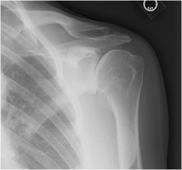 FIGURES 9: X-rays of a very active 57 year-old woman with advanced arthritis of the shoulder. Note the bone spurs and absence of joint space.