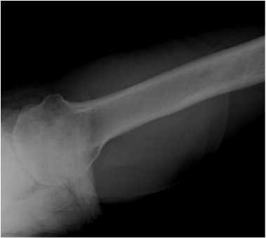 FIGURES 10: X-rays of a very active 57 year-old woman with advanced arthritis of the shoulder. Note the bone spurs and absence of joint space.