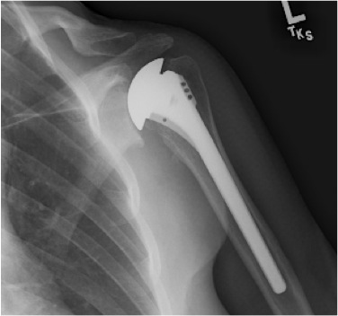 FIGURES 11: X-rays of the same woman in Figures 9 & 10 after the ‘Ream and Run’ procedure. Note that the bone spurs have been removed and that the humeral component has been placed inside of the arm bone. Figure 12 shows space between the metal ball and socket that implies that a new cartilage-like surface has formed.