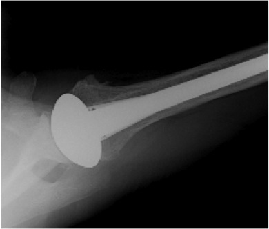 FIGURES 12: X-rays of the same woman in Figures 9 & 10 after the ‘Ream and Run’ procedure. Note that the bone spurs have been removed and that the humeral component has been placed inside of the arm bone. Figure 12 shows space between the metal ball and socket that implies that a new cartilage-like surface has formed.