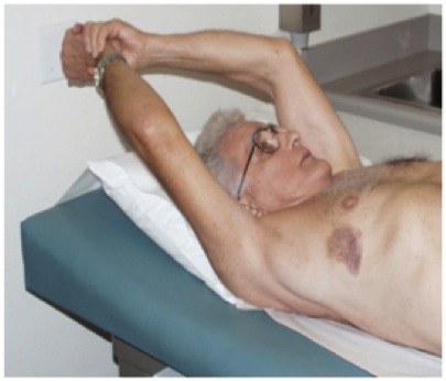 FIGURE 13: A patient doing self-directed exercises following shoulder replacement surgery.