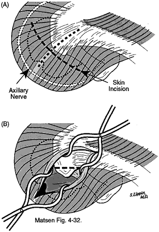 Figure 1 - The tendon near the deltoid is split longitudinally