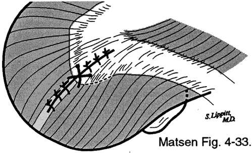 Figure 2 - Strong repair of the deltoid