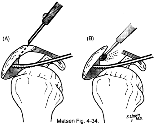 Figure 5 - Rough spots are smoothed with a motorized burr
