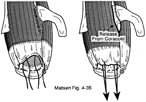 Figure 6 - Minimizing tension on the repair