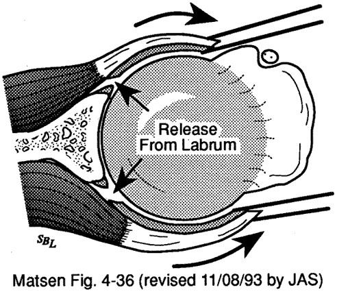 Figure 7 - Release dividing the capsule from the glenoid
