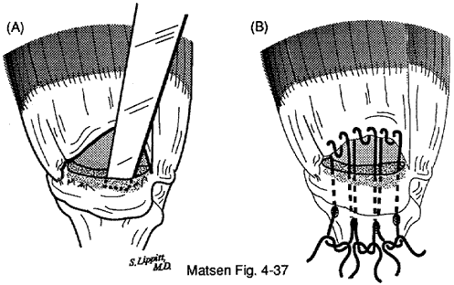 Figure 8 - Tongue in groove repair