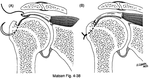 Figure 9 - Drill holes in the distal tuberosity