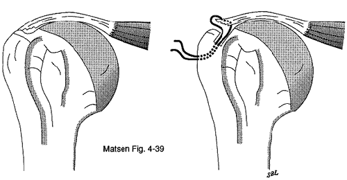 Figure 12 - Consolidating split laminations of cuff