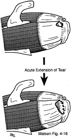 Figure 4 - Major episodes of tendon tearing