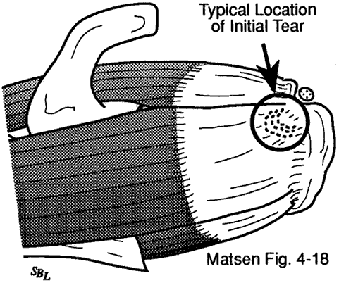 Figure 6 - Degenerative lesions of the cuff generally start at the deep surface of the anterior insertion of the supraspinatus near the long head of the biceps