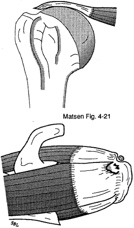 Figure 9 - Full thickness defect