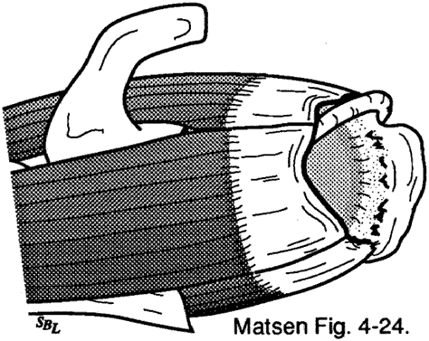 Figure 12 - Destabilization of the long head tendon of the biceps