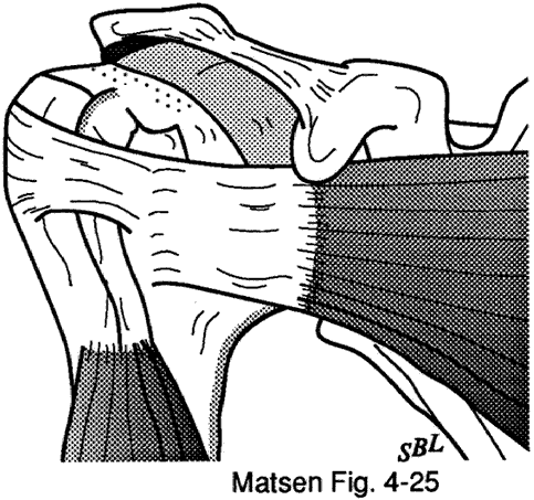 Figure 13 - Boutonniere deformity