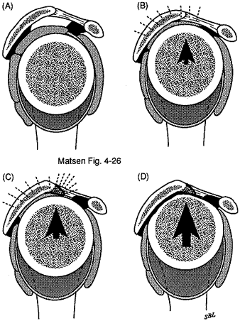Figure 14 - Cuff tear arthropathy
