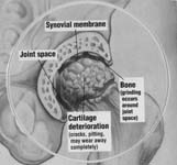 Hip Arthritis - Arthritic Hip Carilage