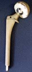 Hip Arthritis - Typical hip replacement components.