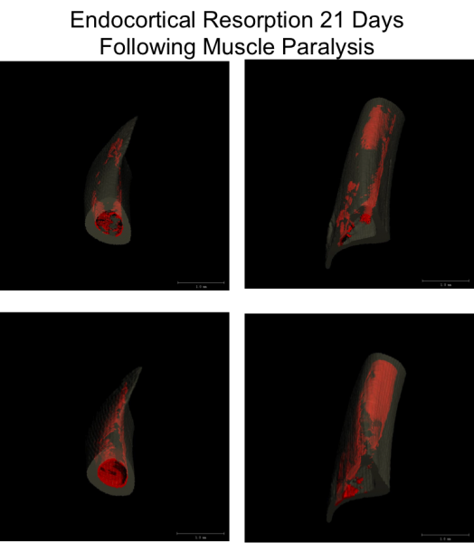 Endocortical Expansion in the tibia of mice following transient muscle paralysis