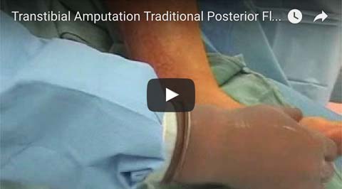 Limb Loss Videos