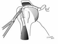 Reverse Total Shoulder Reverse Total Shoulder