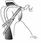 Reverse Total Shoulder Reverse Total Shoulder