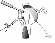 Reverse Total Shoulder Reverse Total Shoulder