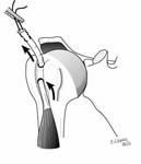 Reverse Total Shoulder Reverse Total Shoulder