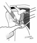 Reverse Total Shoulder Reverse Total Shoulder