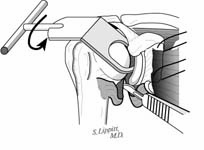 Reverse Total Shoulder Reverse Total Shoulder