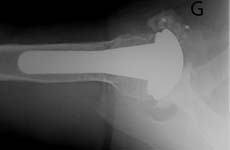 Reverse Total Shoulder