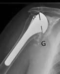 Reverse Total Shoulder