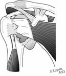 Reverse Total Shoulder