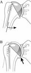 Reverse Total Shoulder