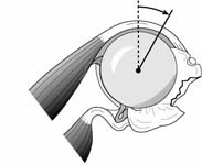 Reverse Total Shoulder