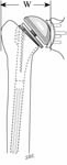 Reverse Total Shoulder