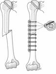 Reverse Total Shoulder