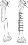 Reverse Total Shoulder